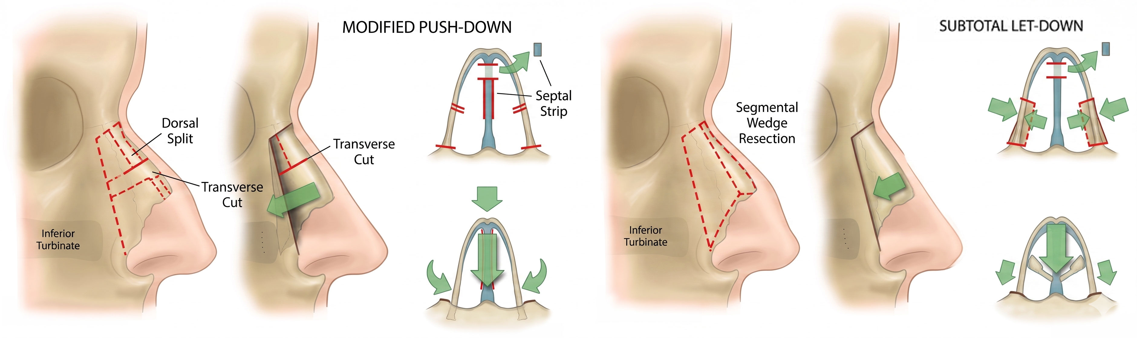 Letdown and Pushdown Rhinoplasty Techniques
