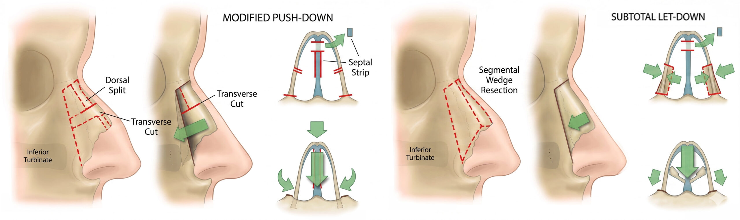 Методы ринопластики Letdown и Pushdown